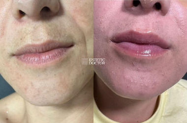 Lip Glow